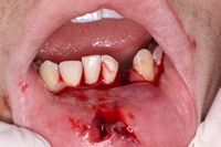 Οδοντικό τραύμα-αθλητισμός